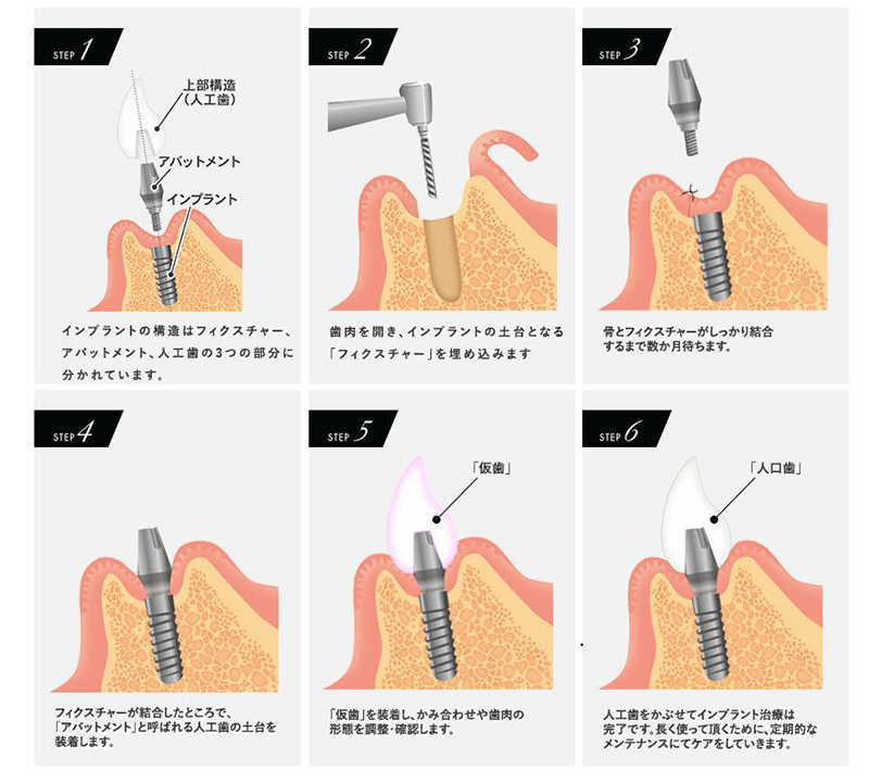 インプラント 仮 歯 いつから